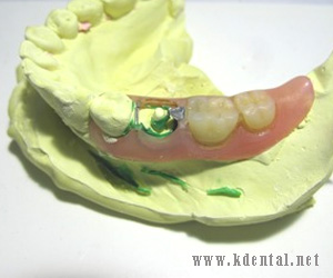 鉤歯が抜歯になった場合の画像