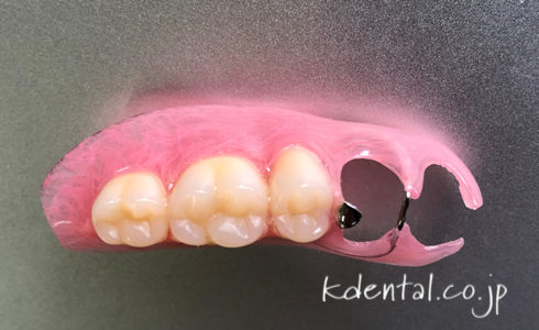 Aiノンクラスプデンチャー（製品詳細） – 歯科技工所｜Kdental