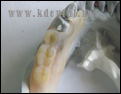 ノンクラスプデンチャーが変色し義歯の症例写真