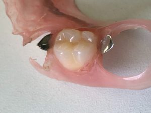 ジルコニア人工歯ノンクラスプデンチャー（その4）
