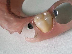 ジルコニア人工歯ノンクラスプデンチャー（その3）