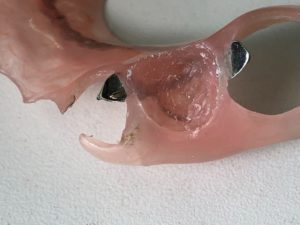 ジルコニア人工歯ノンクラスプデンチャー（その2）