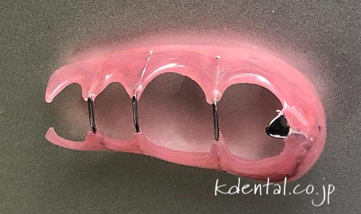 ペリオノンクラスプデンチャー（製品詳細） – 歯科技工所｜Kdental