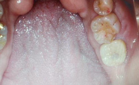 右下７番大臼歯 インプラントの埋入前の口腔内写真と術後ジルコニア上部構造をセットした状態の画像