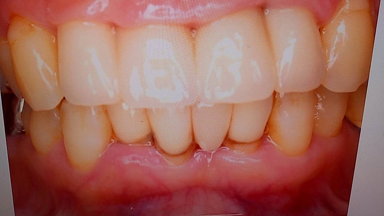 ジルコニアレイヤリングブリッジ連結冠 – 歯科技工所｜Kdental