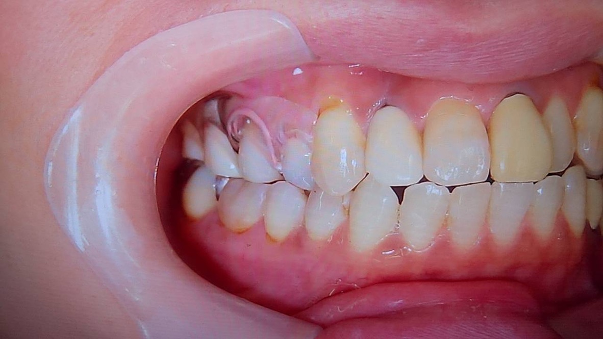 ノンクラスプデンチャー オールクリア画像 – 歯科技工所｜Kdental