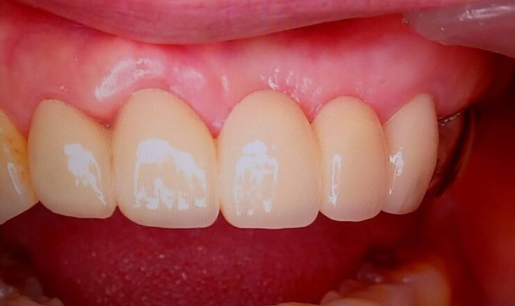 ジルコニアレイヤリングのBrの症例 – 歯科技工所｜Kdental