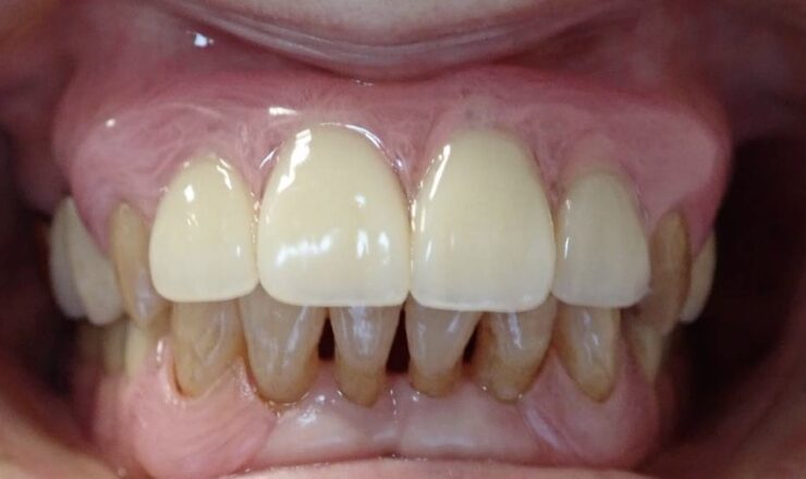 上顎2番～2番まで4本のノンクラスプ AIデンチャー – 歯科技工所｜Kdental