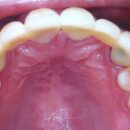 e-max上顎6前歯の症例写真