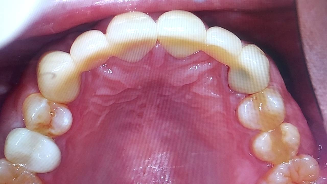 e-max上顎6前歯の症例写真 – 歯科技工所｜Kdental