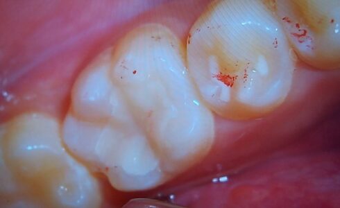 タムインレーのノンステインの症例写真　一級渦洞にはとても良くて　歯牙との移行部も目立ちません