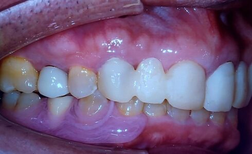 右下4の1本義歯です。 天然歯を形成して、ＢrにせずにAIを選択しました