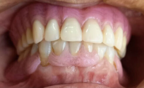アルティメット樹脂で総義歯を作る利点とは？