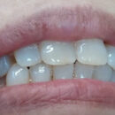 辺側５６７ノンクラスプデンチャーセット　3歯欠損はよくある症例です　安心してセットできます