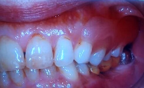 片側567欠損のAIデンチャーの症例です　上顎歯槽頂から下顎臼歯までスペースが少なく見た目以上に難症例でした