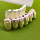 ジルコニアLUXEN Enamel Multi Gradationを使用。メタコネクターをセット変型を防止します。k.dentalでは3本以上の症例より付与しています。調整が終わると、浸透ステインして、自由にカラーリングを行います