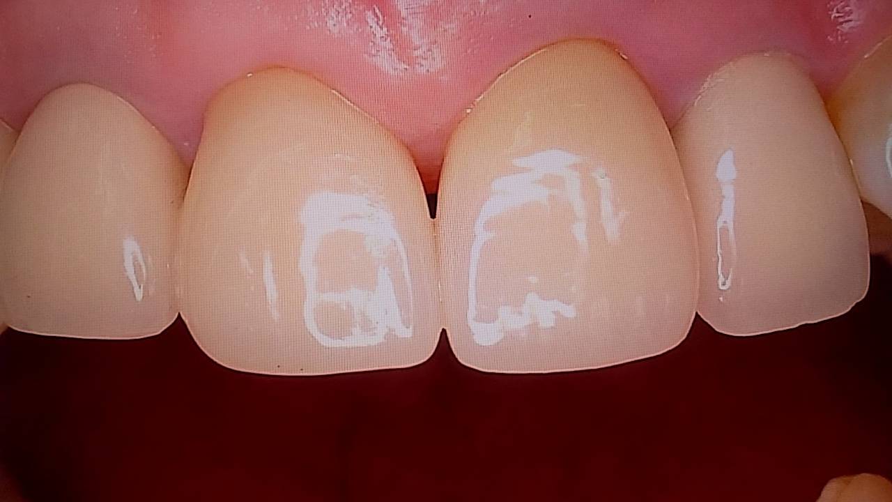 ジルコニアレイヤリングの症例 – 歯科技工所｜Kdental