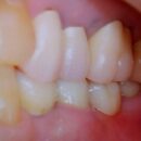 FMZ　Brの症例　患者満足度も高く安心して帰られました　ジルコニアは歯肉との親和性が高い補綴物です