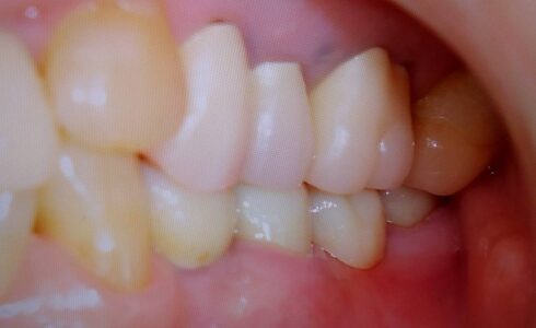 FMZ　Brの症例　患者満足度も高く安心して帰られました　ジルコニアは歯肉との親和性が高い補綴物です