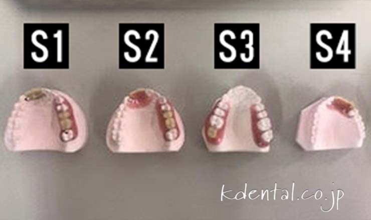 ノンクラスプデンチャー（製品一覧） – 歯科技工所｜Kdental