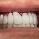 前歯ジルコニアbridgeです　患者様のご希望で白いシェードです 最近は白い歯を入れる人も増えています