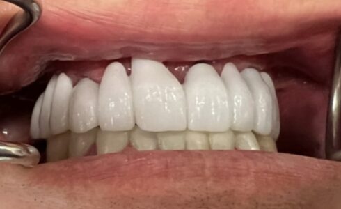 前歯ジルコニアbridgeです　患者様のご希望で白いシェードです 最近は白い歯を入れる人も増えています