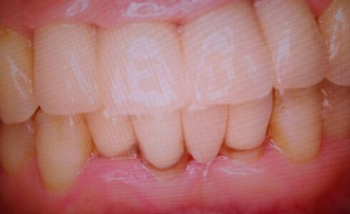 ジルコニアの2112の連冠 ジルコニアは歯肉生体親和性が高いので今後は長期に保存できるでしょう