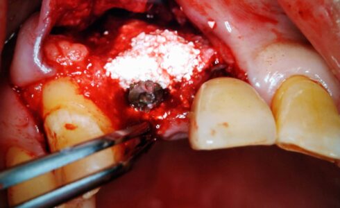 上顎2番のインプラント上部構造ジルコニアの症例　 術前埋入予定部位の骨量が少なく　骨補填で増骨して完成セット