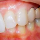 3番e-maxの症例です　ほぼ天然歯と同化　
