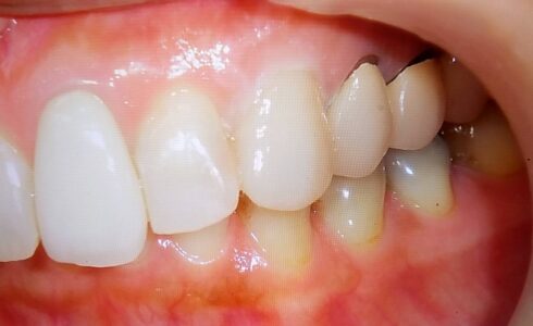 3番e-maxの症例です　ほぼ天然歯と同化　