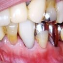 口腔内スキャンで印象したCADCAM冠の症例 ４歯以内なら口腔内スキャナーどれでも、アイテロでも適合良好 