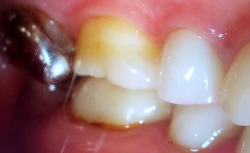 上顎6番e-maxｱﾝﾚｰ　口腔内写真歯冠中央部にマージンがありますが目立ちません 遠心の窪みは歯質の変色によるものでマージンはきれいに適合しています