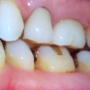 左上4番　5番e.max連冠　症例　自然感があり　天然歯に近い摩耗硬度