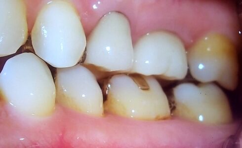 左上4番　5番e.max連冠　症例　自然感があり　天然歯に近い摩耗硬度