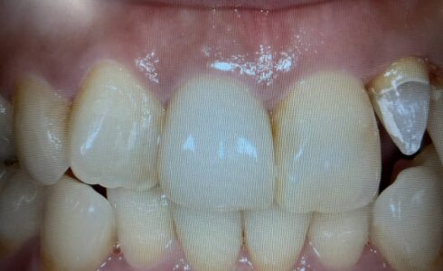 右側1番e.max 　e.max は審美性に優れ　摩耗硬度も天然歯に近い優れた材料です