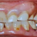 オールクリア上顎2番１本義歯　オールクリアはほとんど目立たない 少数歯の欠損において優位性があり　入れ歯と気づかれないデンチャーとなります