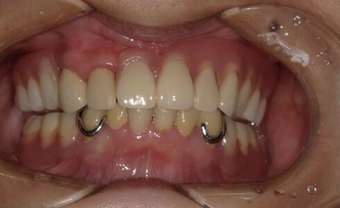 インプラントアタッチメント義歯はしっかりした固定で安定して噛むことができます 患者の満足度も高く完成できました
