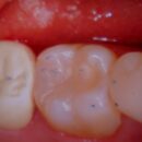 ピークの症例写真 PEEKは最も強固なエンジニアリングプラスチック　ショックアブソーバー機能もあり　臼歯の補綴にはピッタリ　最後臼歯も無調整でセットされました　隣接や咬合の正確性は適合良い補綴物の証明です
