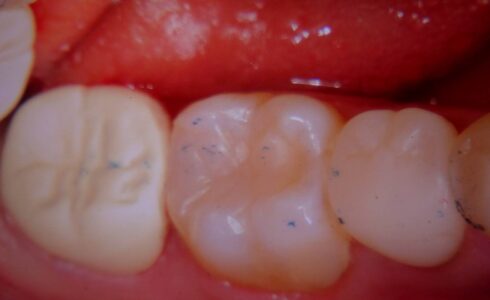 ピークの症例写真 PEEKは最も強固なエンジニアリングプラスチック　ショックアブソーバー機能もあり　臼歯の補綴にはピッタリ　最後臼歯も無調整でセットされました　隣接や咬合の正確性は適合良い補綴物の証明です