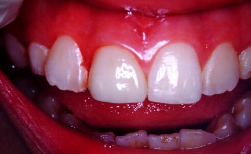 右上１番のe-maxの症例写真　e-maxは最も天然歯に近い摩耗硬度を持ち色調も近似しています