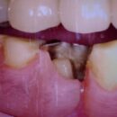 ノンクラスプデンチャーに合わせた鉤歯のe-max作製補綴症例