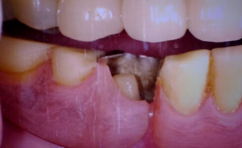 ノンクラスプデンチャーに合わせた鉤歯のe-max作製補綴症例