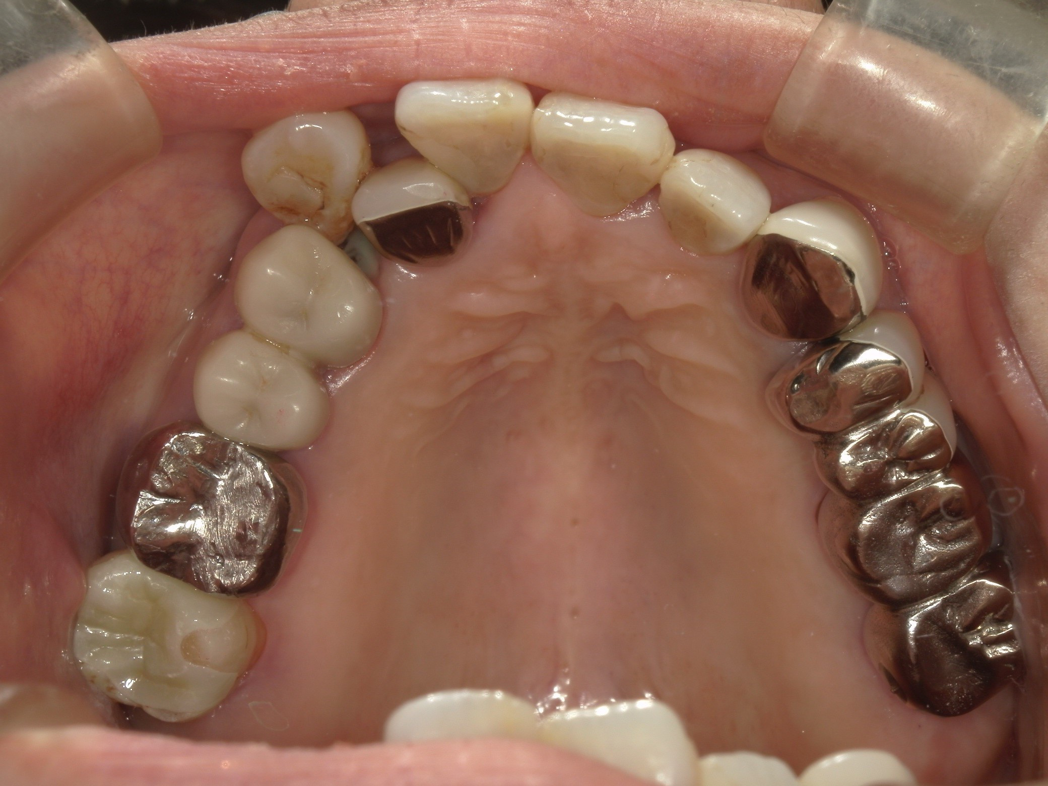 金歯　端材　インレー 26534.jpg