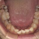 セットで注意すべきは　きちんと研磨してセットが必須です そうしないと対合歯がヤスリで削れたように無くなります もう一つメタルレス技工に必須なのが　内面のサンドブラストです一度でも仮着してしまうと、汚染されてしまいます