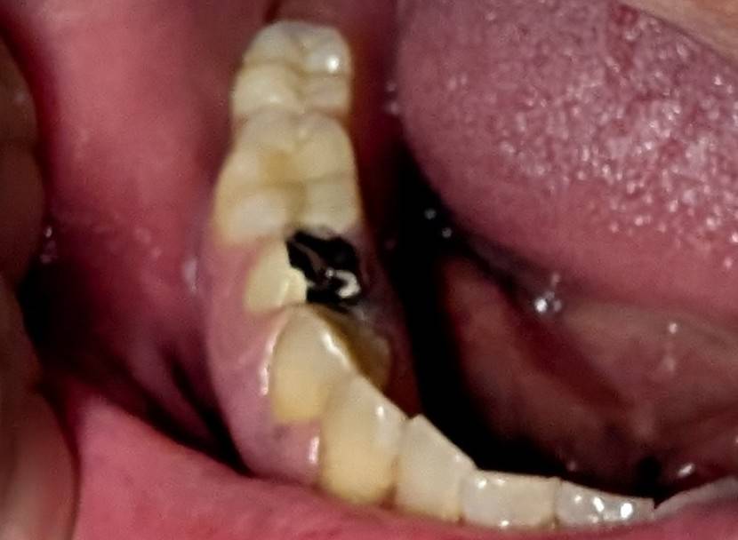 右下67アルティメットデンチャーセット – 歯科技工所｜Kdental