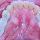下顎両側456のインプラントハイブリッドの上部構造 クリアランスが無くバイト調整に苦心しました。対合歯は弊社製作のジルコニアフルマウスです。