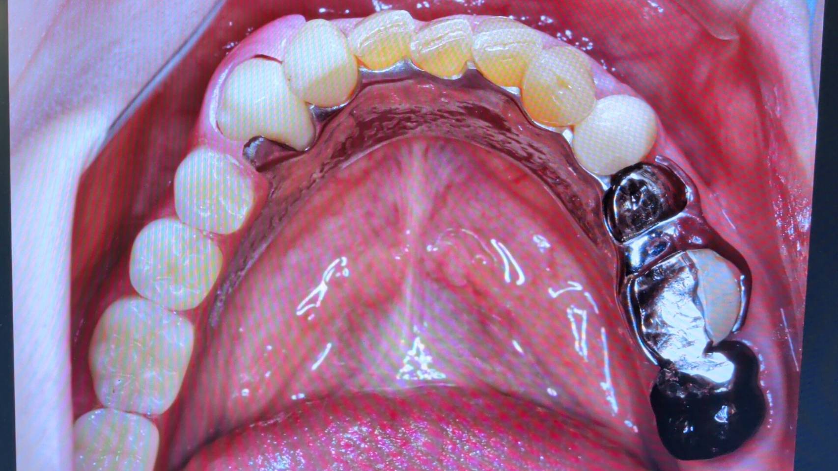 右下4567のAIバータイプ – 歯科技工所｜Kdental