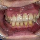 ノンクラスプデンチャーセット完了 大きな症例でしたが 綺麗にセットでき咬合も安定していました