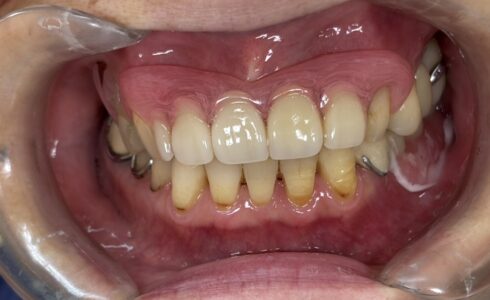 ノンクラスプデンチャーセット完了　大きな症例でしたが　綺麗にセットでき咬合も安定していました