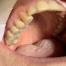 右上567　ジルコニアBr